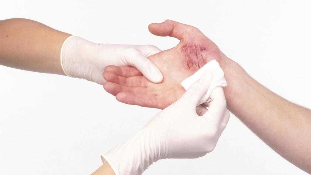 рана на руке