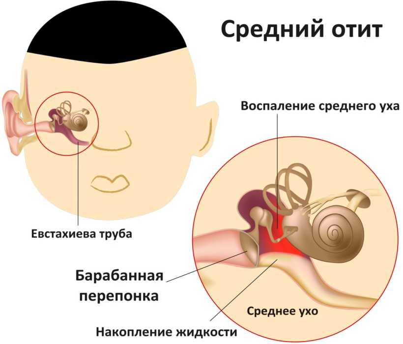схема отита уха
